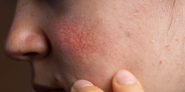 Quelques solutions pour apaiser et traiter la couperose